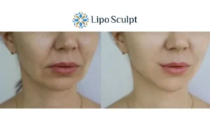 Explaining Total Skin Tightening Treatment And What It Can Do For You 2 Do you want to boost your self confidence? Give Morpheus8 Redbourn a try today!