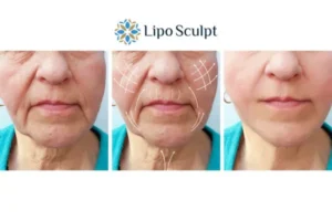 Explaining Total Skin Tightening Treatment And What It Can Do For You 3 Boost your confidence with Morpheus8 Redbourn call our team today!