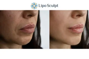 Explaining Total Skin Tightening Treatment And What It Can Do For You 4 Morpheus8 Redbourn the best results - call our team today!