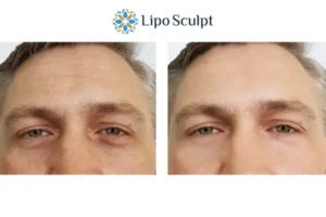 Explaining Total Skin Tightening Treatment And What It Can Do For You 6 Morpheus8 Redbourn book in today to find out more!