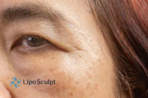 Cryopen: The Revolutionary Treatment for Age Spots Unveiled 2 Are age spots Redbourn giving you low self esteem? Contact us today!