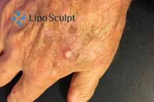 Best Actinic Keratoses Removal 2 Improve your wellbeing and health with Actinic Keratoses Redbourn removal.treatment