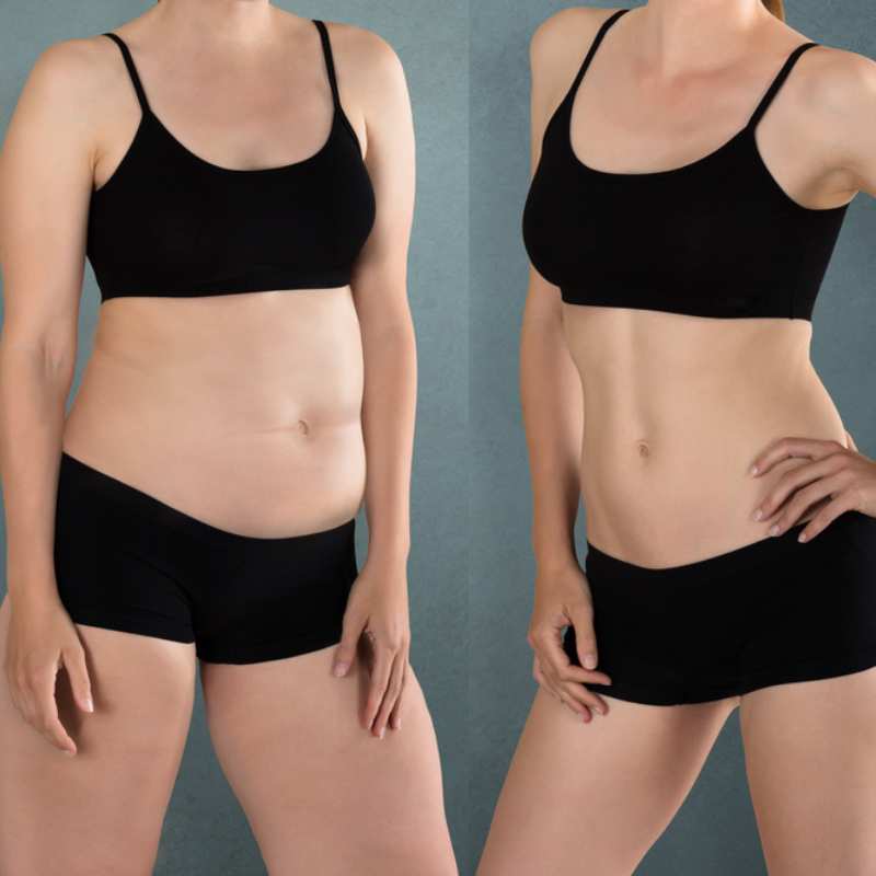 Does Fat Freezing at Home Work? DIY Devices vs Professional Cryolipolysis 2 before and after Cryolipolysis Redbourn