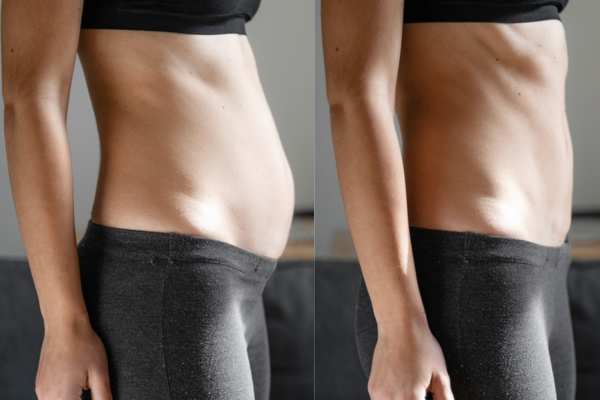 Non-Surgical Options for Diastasis Recti: What You Need to Know About Tone Sculpt 4 diastasis recti treatment