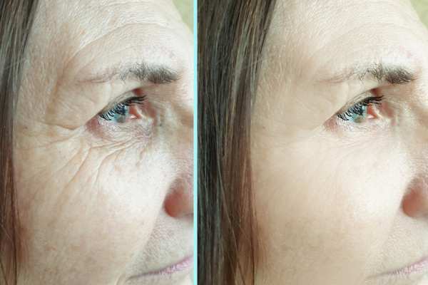 Why Do People Choose HIFU for a Non-Surgical Facelift? 4 How long can HIFU results last Redbourn?