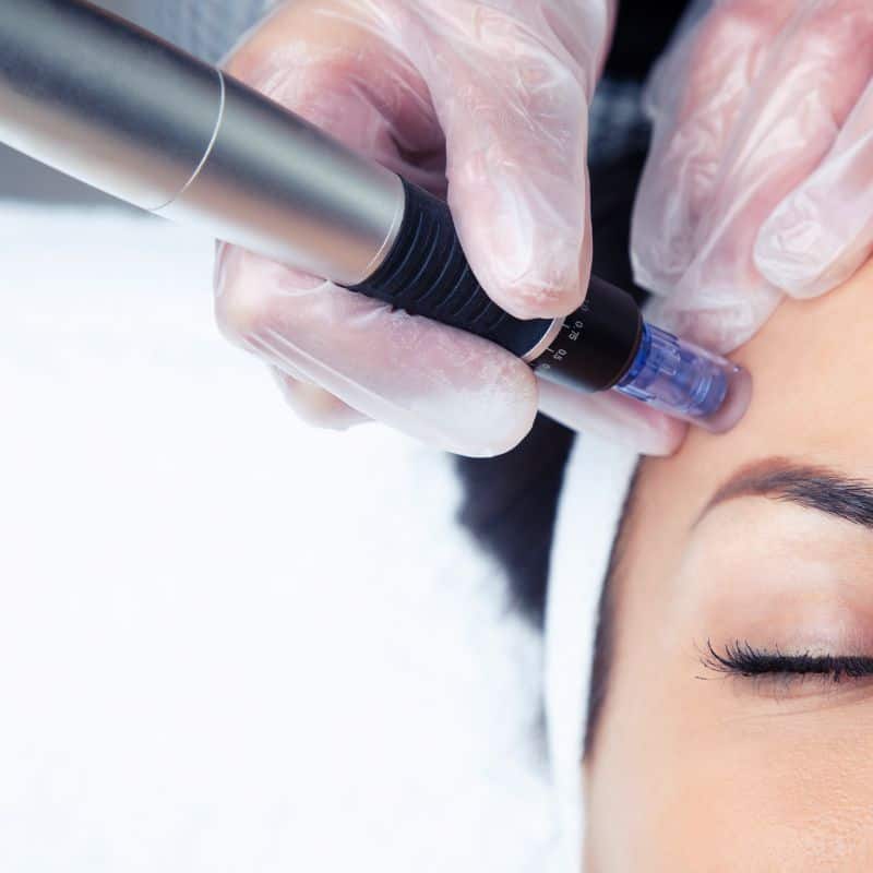 Morpheus8 treatment Redbourn from Lipo Sculpt - Book in today!