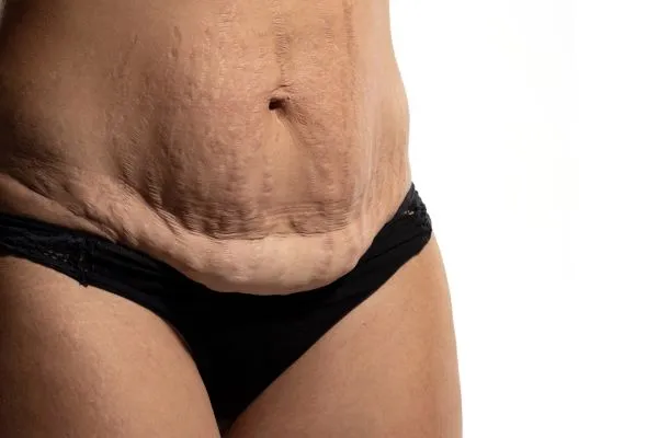 Lost the Weight but Not the Loose Skin? 1 image of womans stomach after weight loss showing loose skin Redbourn