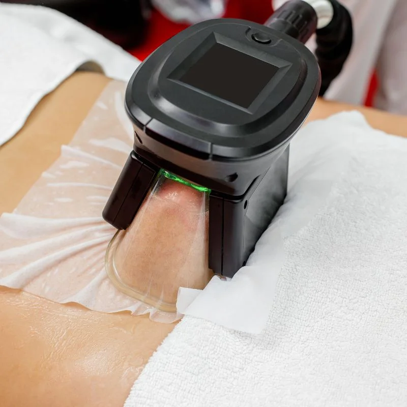 Fat Freezing treatment Redbourn